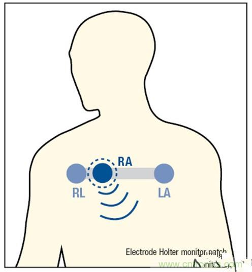 解析：一款可穿戴無線ECG動(dòng)態(tài)心電監(jiān)護(hù)儀的設(shè)計(jì)